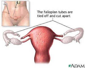 Tubes Tied (Blocked Fallopian Tubes)