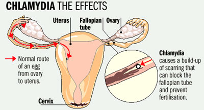 chlamydia during pregnancy