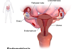 Endometriosis – Major Infertility Cause in Women