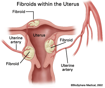 fibroids-in-uterus